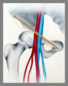 femoral vein presentment